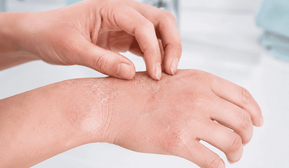 skin hard water